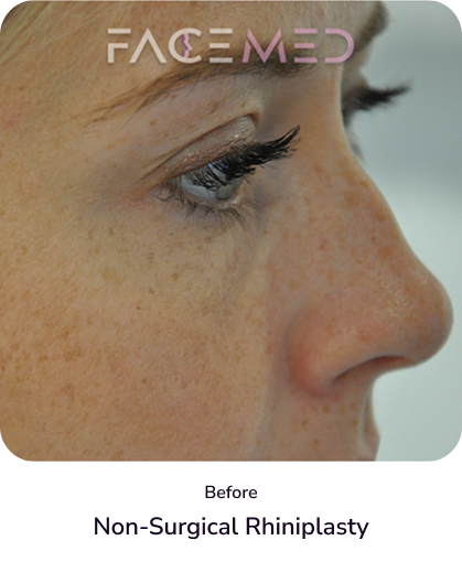 rhinoplasty_1_before