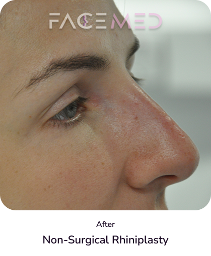 rhinoplasty_2_after