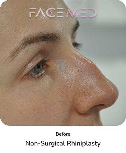 rhinoplasty_2_before