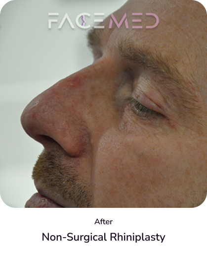 rhinoplasty_3_after