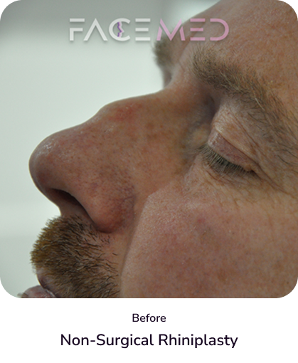 rhinoplasty_3_before