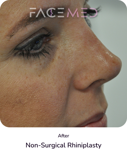 rhinoplasty_4_after
