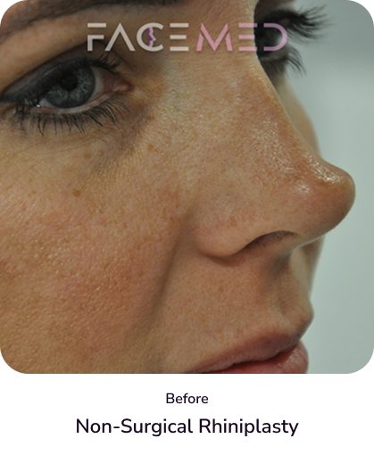 rhinoplasty_4_before
