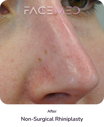 rhinoplasty_5_after