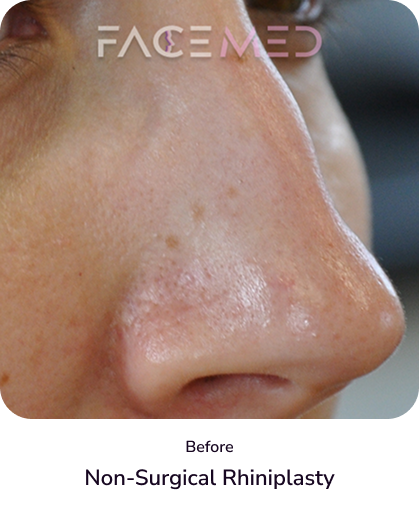 rhinoplasty_5_before